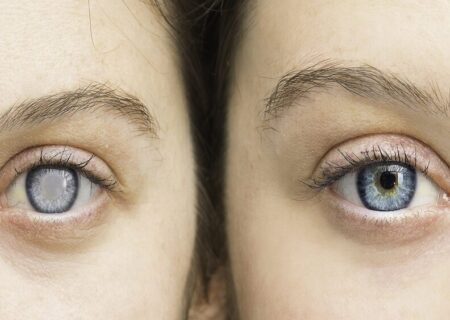 خشکی چشم در زنان شایع‌تر از مردان است