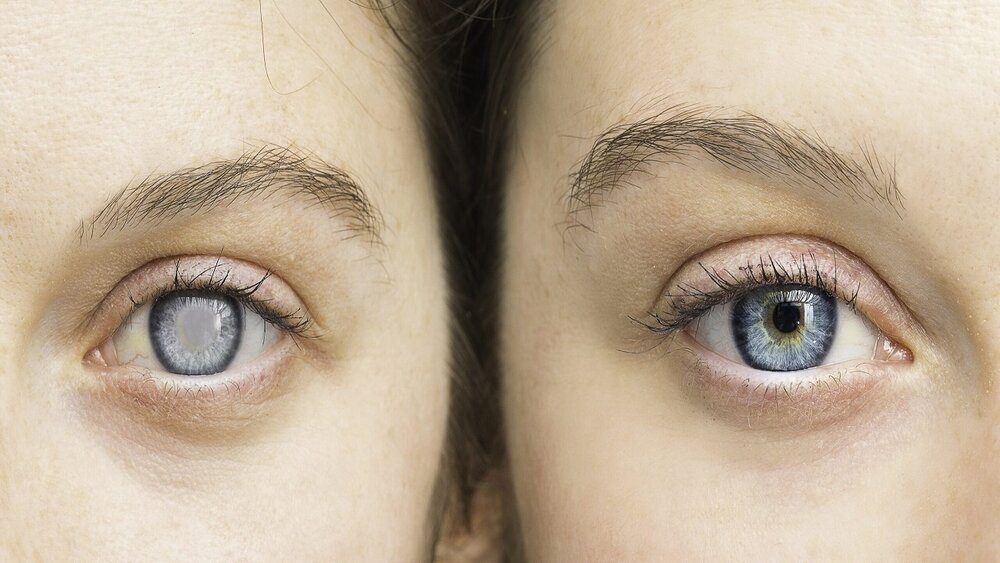 خشکی چشم در زنان شایع‌تر از مردان است