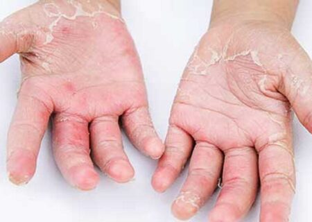 نشانه های پوستی کرونا چیست؟