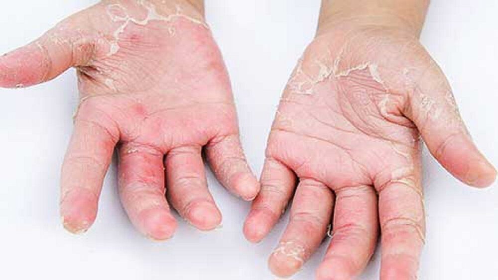 نشانه های پوستی کرونا چیست؟