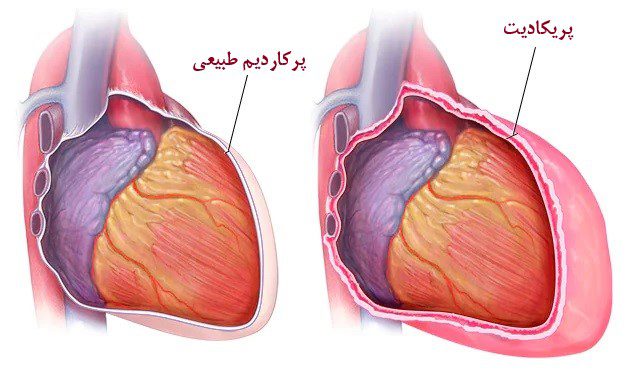 قلب پریکارد