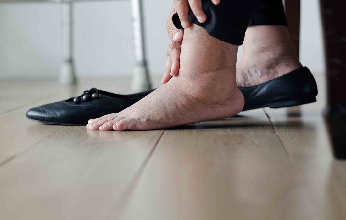 رایج‌ ترین دلایل تورم پا‌ها چیست؟
