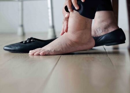رایج‌ ترین دلایل تورم پا‌ها چیست؟