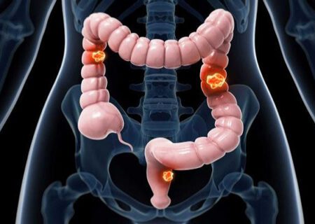 سرطان‌ های گوارش سومین سرطان شایع دنیا هستند