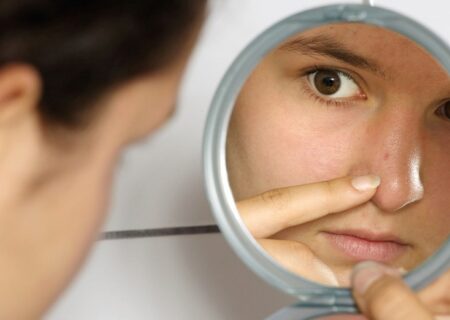 روش هایی برای درمان جای جوش روی صورت
