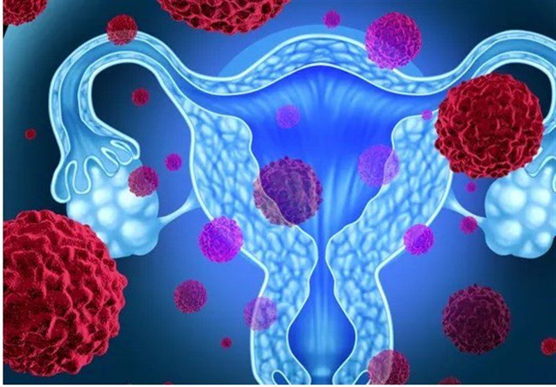 راه های پیشگیری از سرطان شایع زنان