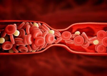 از کجا بفهمیم در بدنمان “لخته خون” داریم؟