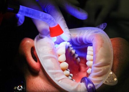 ایجاد مینای دندان با سلول‌ های بنیادی
