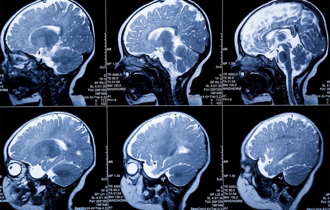 شناسایی زودهنگام سرطان‌ مغز و پروستات با MRI نانویی