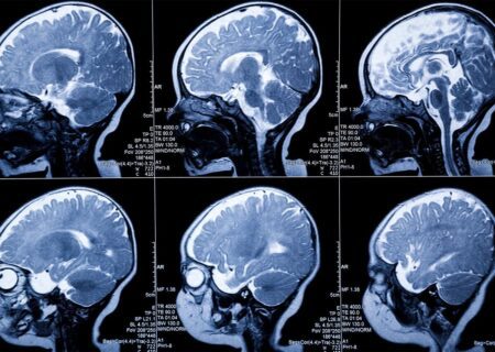 شناسایی زودهنگام سرطان‌ مغز و پروستات با MRI نانویی