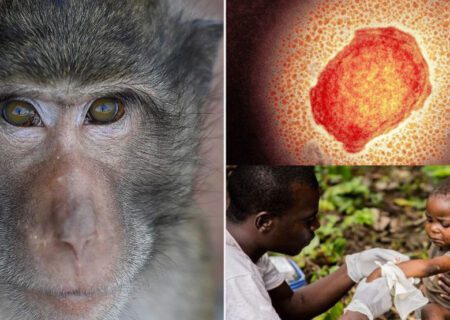 تفاوت‌ ها و شباهت‌ های علائم آبله میمون و بیماری زونا