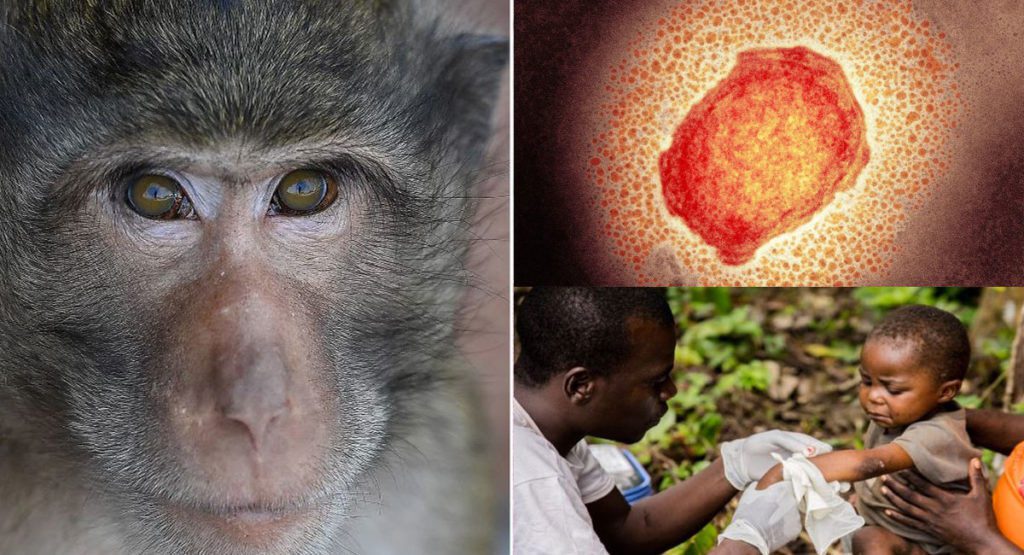 تفاوت‌ ها و شباهت‌ های علائم آبله میمون و بیماری زونا