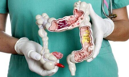 سرطان کولورکتال را بهتر بشناسید
