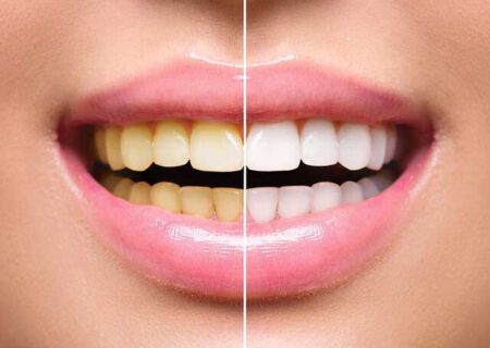 علل زرد شدن دندان ها چیست؟