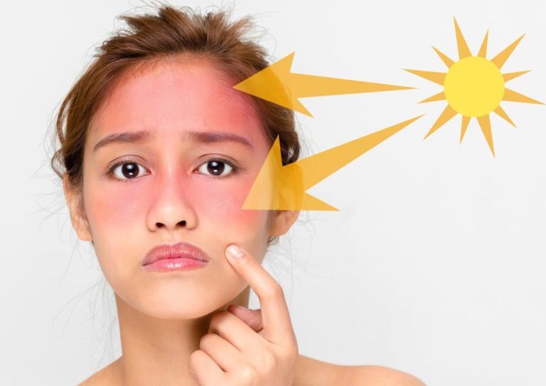 برای جلوگیری از آفتاب سوختگی چه بخوریم؟