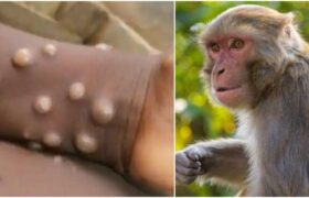 علائم جدید آبله میمون چیست؟