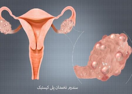 درمان سندرم تخمدان پلی کیستیک