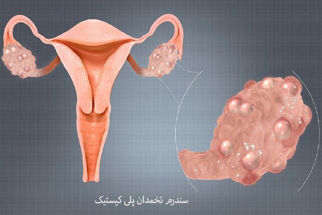 درمان سندرم تخمدان پلی کیستیک