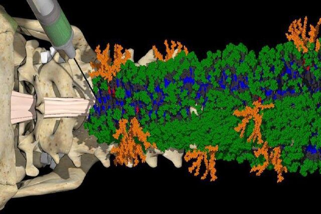یک درمان تزریقی برای ترمیم آسیب‌ های نخاعی