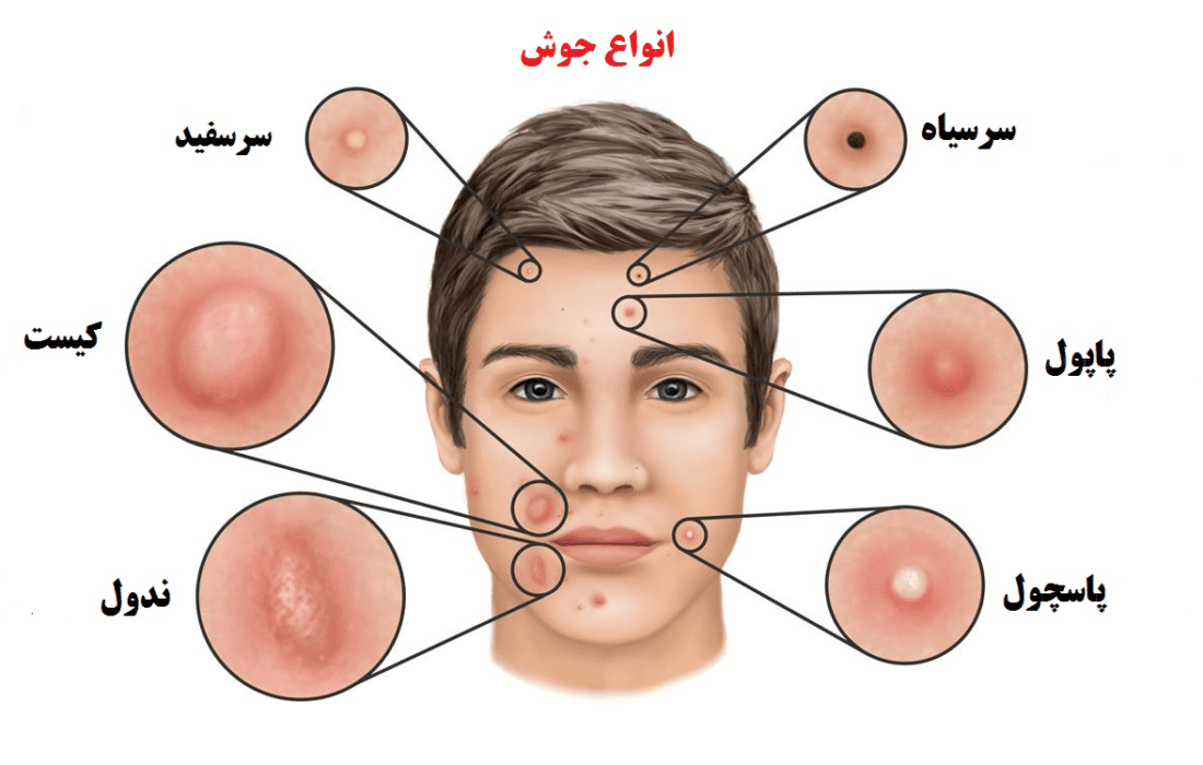 انواع جوش صورت و راهکارهایی معجزه آسا برای درمان آن