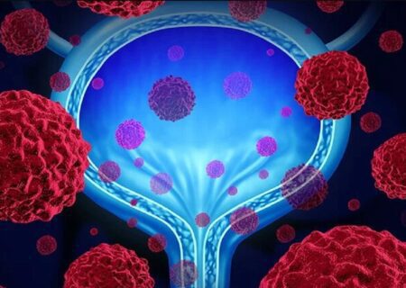 درمان سرطان مثانه با داروی آتزولیزومب