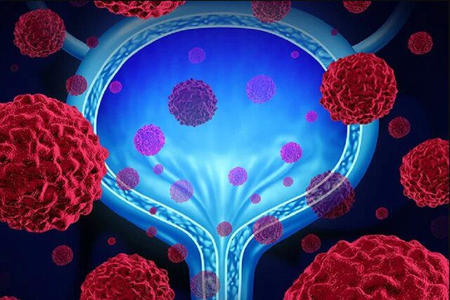 درمان سرطان مثانه با داروی آتزولیزومب