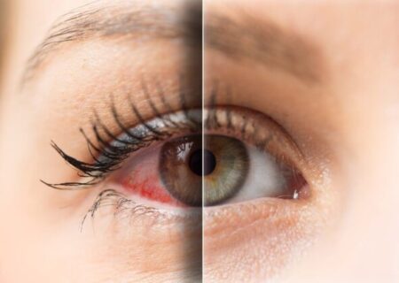 رابطه میان خشکی چشم و آسم چیست؟