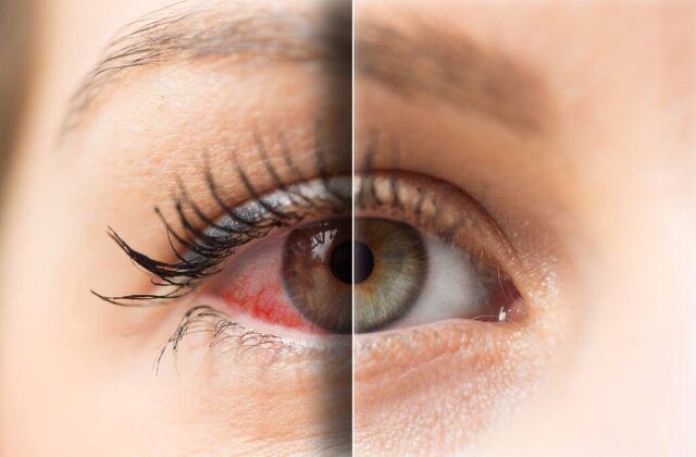 رابطه میان خشکی چشم و آسم چیست؟