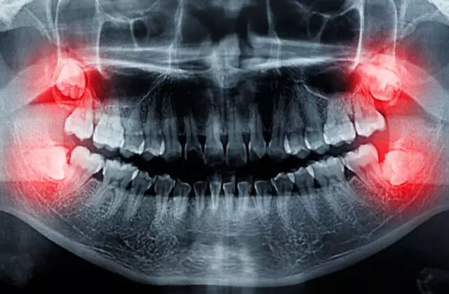 کشیدن دندان عقل عکس دندان عقل