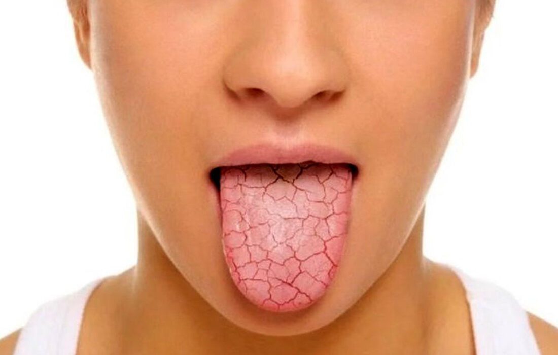 رایج ترین علل خشکی دهان