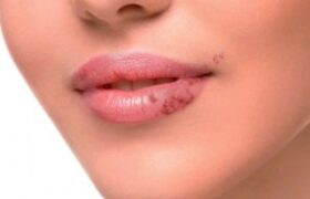 چرا تبخال می زنیم ؟