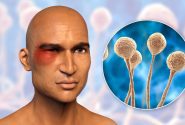 از بیماری قارچ سیاه چه می دانید؟