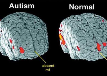 زمان طلایی تشخیص اوتیسم را نباید از دست داد