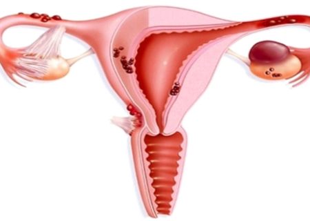 آندومتریوز موجب نازایی زنان می‌شود