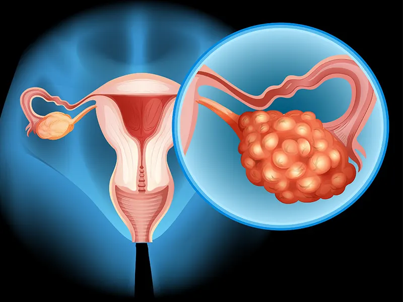 سرطان تخمدان؛ از علائم تا درمان