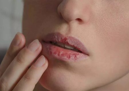 خشکی دهان نشانه کدام بیماری است؟