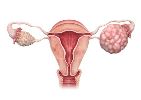 معرفی روش جدیدی برای تشخیص زودهنگام سرطان تخمدان
