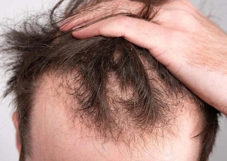 توضیحات مهم یک متخصص درباره عوارض دو داروی ریزش مو