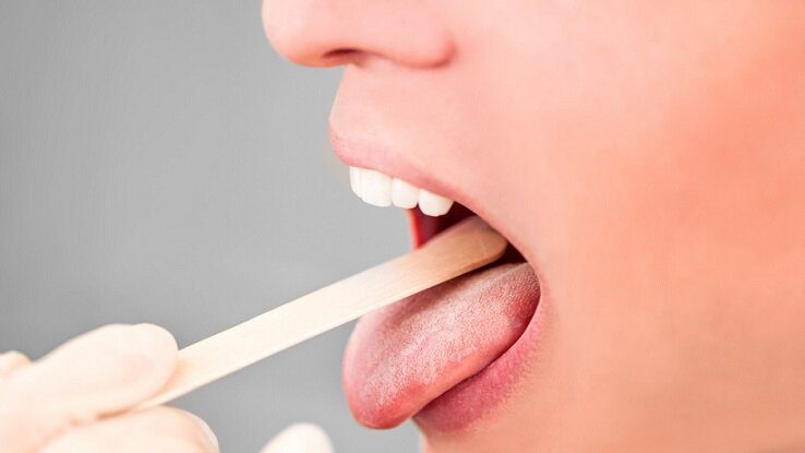 تشخیص چه بیماری‌هایی از روی زبان امکان‌پذیر است؟