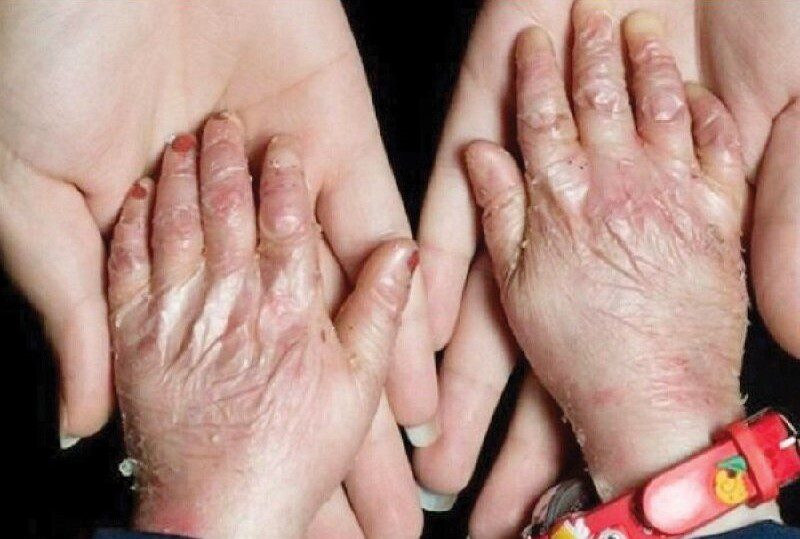 ۸۰ درصد بیماری‌های نادر ژنتیکی است