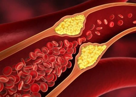 کاهش چربی خون با راهکارهای خانگی و ساده