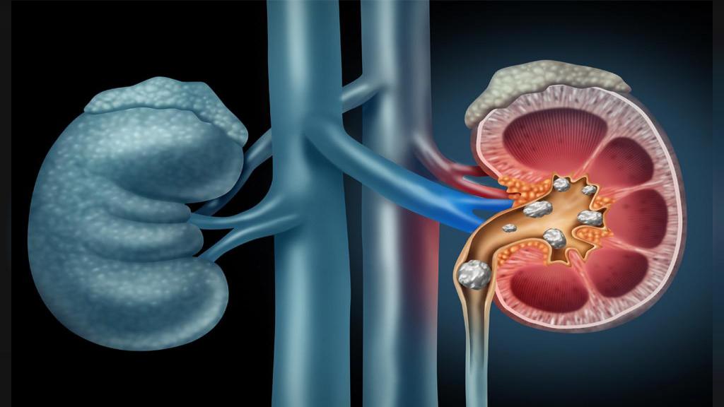 علائم سنگ کلیه در زنان چیست؟