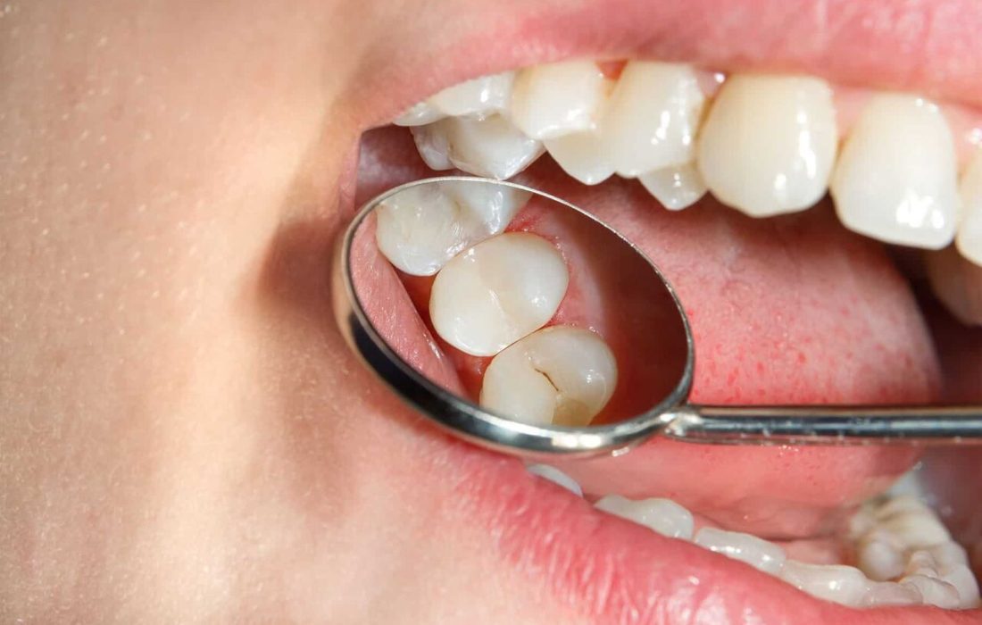 کاهش پوسیدگی‌های دندانی با کنترل مصرف قند