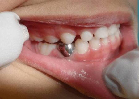 روکش استیل دندان چه کاربردی برای دندان شیری و دائمی دارد؟