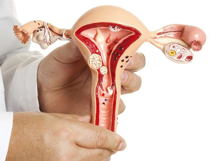 علائم اندومتریوز کدامند؟ نشانه‌های آندومتریوز خفیف و شدید چیست؟