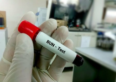 آزمایش BUN یا نیتروژن اوره خون چیست؟