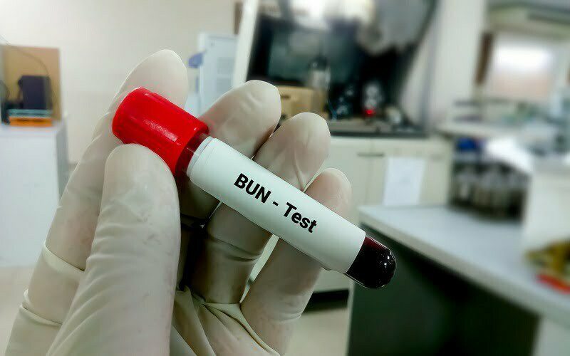 آزمایش BUN یا نیتروژن اوره خون چیست؟