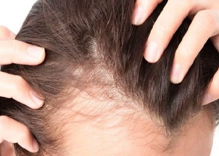 نازک شدن مو، علل و راه‌های درمان این مشکل