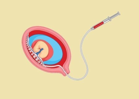 تست نمونه برداری از پرزهای جفت (cvs) چیست و چه عوارضی دارد؟