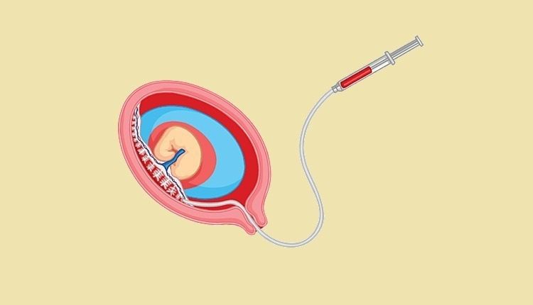 تست نمونه برداری از پرزهای جفت (cvs) چیست و چه عوارضی دارد؟